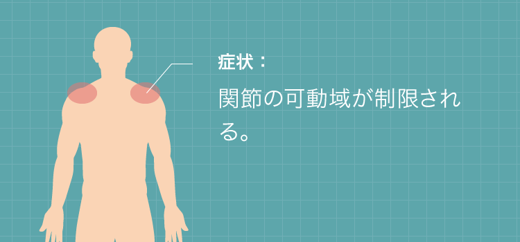 関節の可動域が制限される。