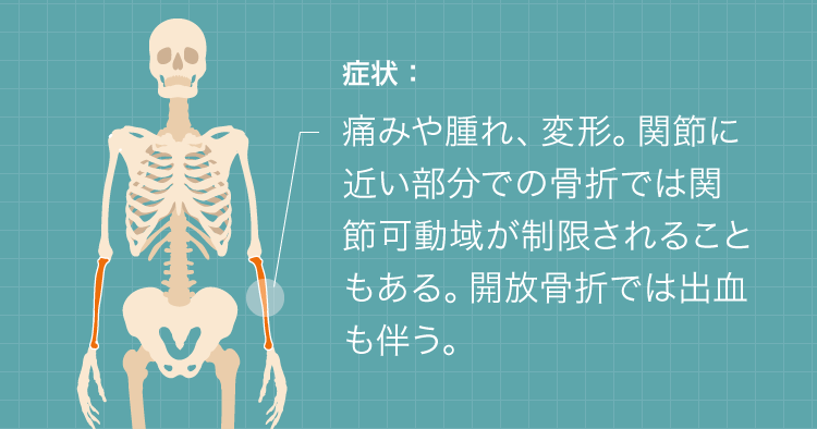 痛みや腫れ、変形。関節に近い部分での骨折では関節可動域が制限されることもある。開放骨折では出血も伴う。